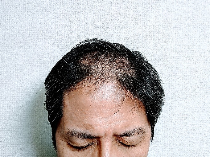 AGAとは
